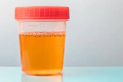 Plastic container with sample of urine for analysis Stock Photos