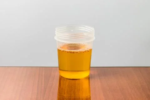 Plastic container with sample of urine for analysis Stock Photos