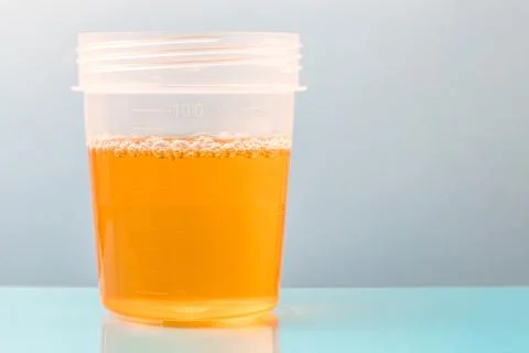 Plastic container with sample of urine for analysis Stock Photos
