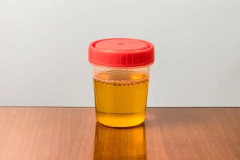 Plastic container with sample of urine for analysis Stock Photos