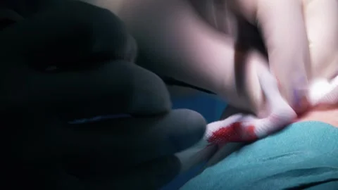 Plastic eyelid surgery. Stock Footage 278042312