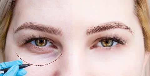 Plastic surgeon drawing dashed line under eye of girl. Hand in blue glove Foto stock