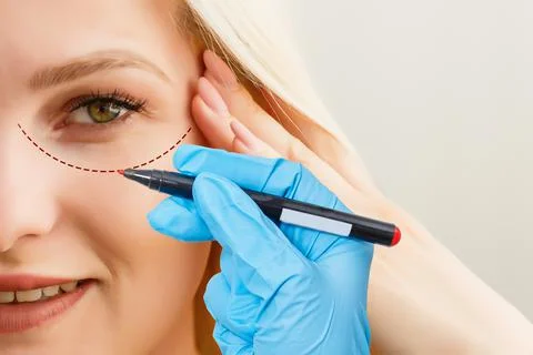 Plastic surgeon drawing dashed line under eye of girl. Hand in blue glove Foto stock