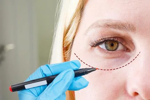 Plastic surgeon drawing dashed line under eye of girl. Hand in blue glove Foto stock