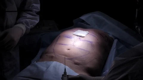A plastic surgeon finished markup for the operation of liposuction and Stock-Footage 123677669