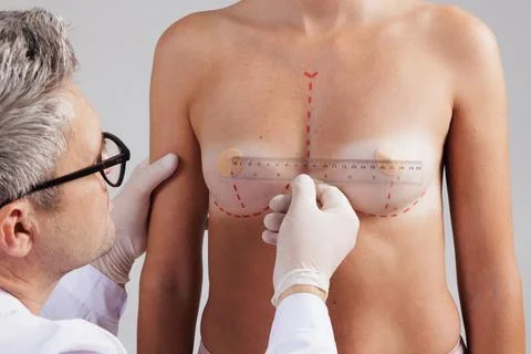 A plastic surgeon makes markings with a ruler on a woman's breast, mammoplast Stock Photos