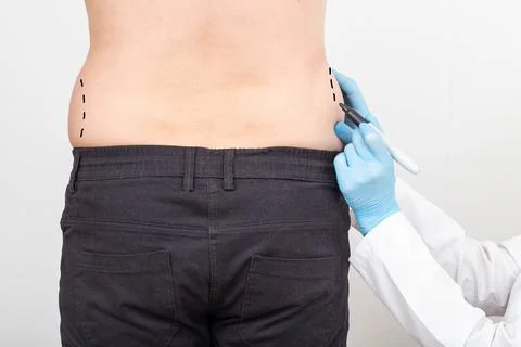 The plastic surgeon makes marks with a marker on the problem areas of the Foto stock