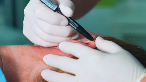 A plastic surgeon makes marks on a woman's face, marks on her ears, preparing Stock Footage 230154863