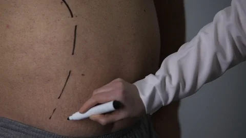 Plastic surgeon marking incision lines o... | Stock Video | Pond5