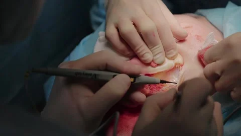 Plastic surgeon performs facelift surgery 動画素材 148046671