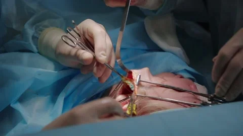 Plastic surgeon performs facelift surgery 動画素材 148046949