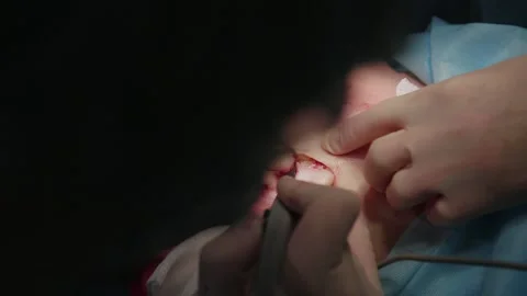 Plastic surgeon performs facelift surgery 動画素材 148047122