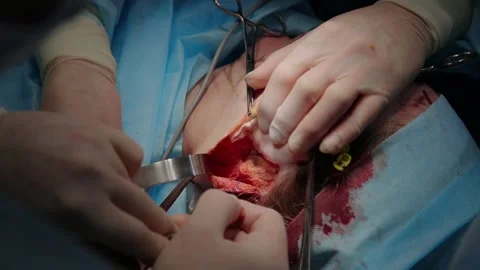 Plastic surgeon performs facelift surgery 動画素材 148047139