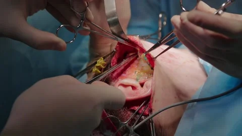 Plastic surgeon performs facelift surgery 動画素材 148047320