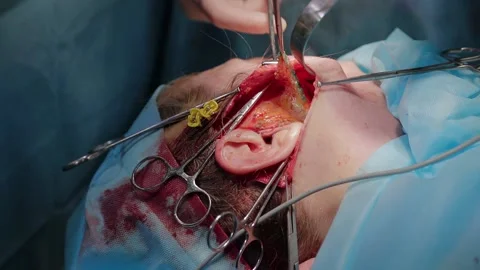 Plastic surgeon performs facelift surgery 動画素材 148047399