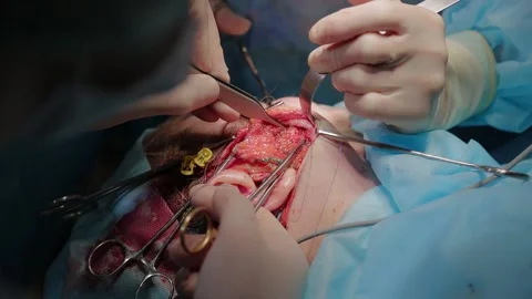 Plastic surgeon performs facelift surgery 動画素材 148047439