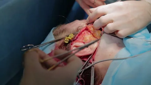 Plastic surgeon performs facelift surgery 動画素材 148047498