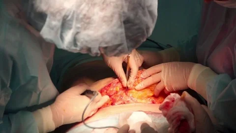 Plastic surgeon performs an operation for abdominoplasty with a transfer of the  Stock Footage 70003513