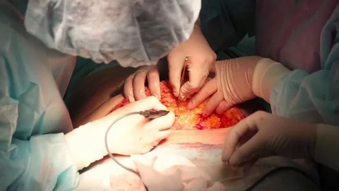 Plastic surgeon performs an operation for abdominoplasty with a transfer of the  스톡 동영상 70003515