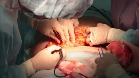 Plastic surgeon performs an operation for abdominoplasty with a transfer of the  Video stock 70003569