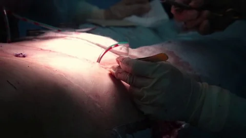 Plastic surgery on the abdomen 스톡 동영상 70003879