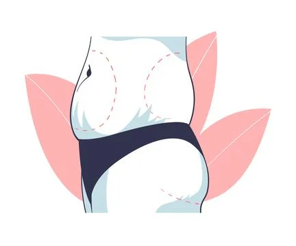 Plastic Surgery with Belly Body Part Correction in Aesthetic Beauty Clinic Stock Illustration