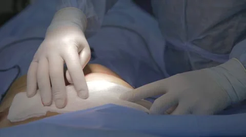 Plastic surgery breast augmentation Stock Footage 68453757