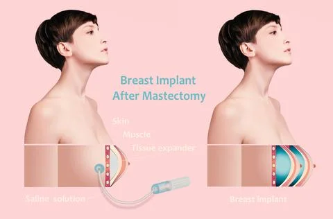 Plastic surgery of breast implants Stock Illustration