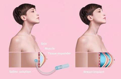 Plastic surgery of breast implants Stock Illustration
