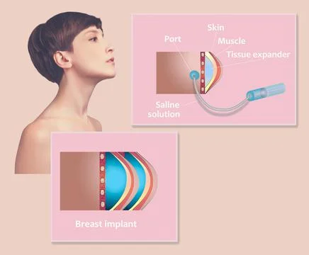 Plastic surgery of breast implants Stock Illustration