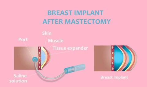 Plastic surgery of breast implants Stock Illustration