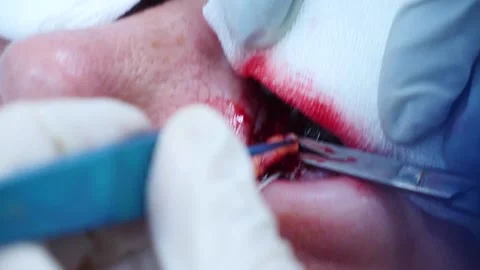 Plastic surgery. Close up of a surgeon removing piece of fat from eyelid Stock Footage 145602302