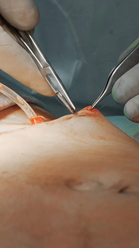 Plastic surgery. close-up. the surgeon sutures a large incision in patient's Stock Footage 316463618