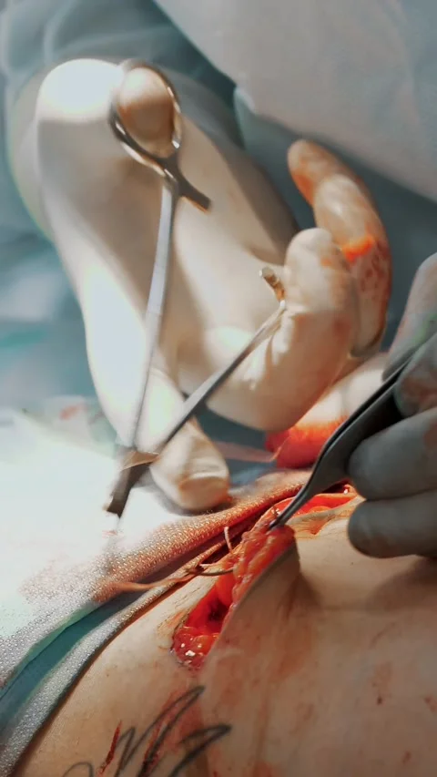Plastic surgery. close-up. the surgeon sutures a large incision in patient's Stock Footage 316891219
