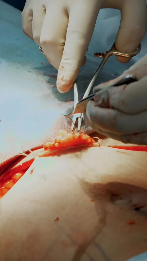 Plastic surgery. close-up. the surgeon sutures a large incision in patient's Stock Footage 318682633