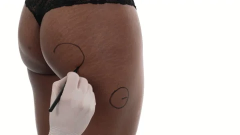 Plastic surgery doctor pointing out the problem parts of woman body. Buttock Stock Footage 155998726