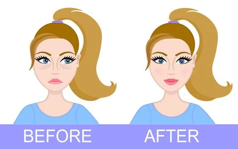 Plastic surgery of eyelids, operation removal of bags under eyes. Blepharoplasty Stock Illustration
