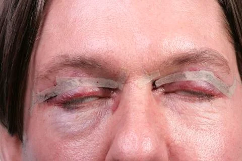 Plastic surgery on eyes Stock Photos