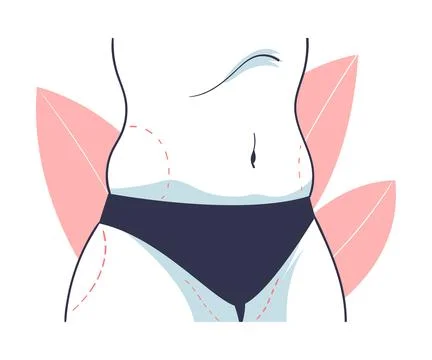 Plastic Surgery with Fat on Belly Correction in Aesthetic Beauty Clinic Vector Stock Illustration