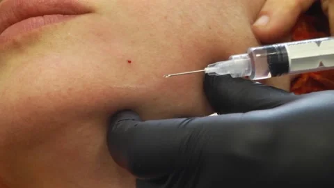 Plastic surgery injection Video stock 107860858