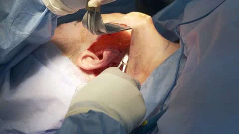 Plastic surgery to lift the neck and chin Stock Footage 167520835