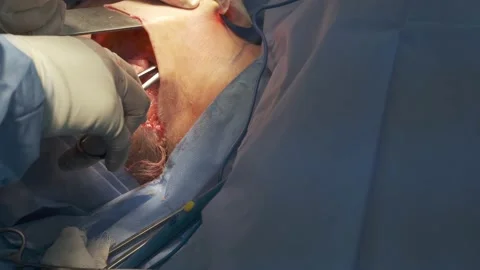Plastic surgery to lift the neck and chin Stock Footage 167522611