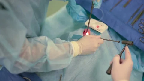 Plastic surgery on nasal septum, curing of snoring and cosmetic operation 스톡 동영상 166800055