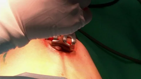 Plastic surgery an operating room Vidéo 75987640