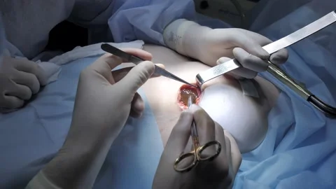 Plastic surgery operation. Breast augmentation silicone implant inside patient's Stock Footage 221765298
