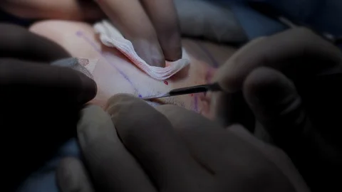Plastic surgery operation closeup. Surgeon hands making an incision with scalpel Stock-Footage 129843311
