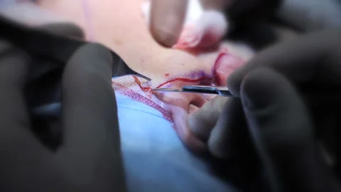 Plastic surgery operation. Facelift. Doctor surgeon hands holding the forceps Stock-Footage 221783064