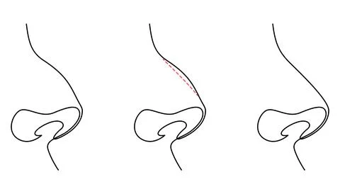 Plastic surgery performed on the nose continuous one line drawing. Before a.. Stock Illustration