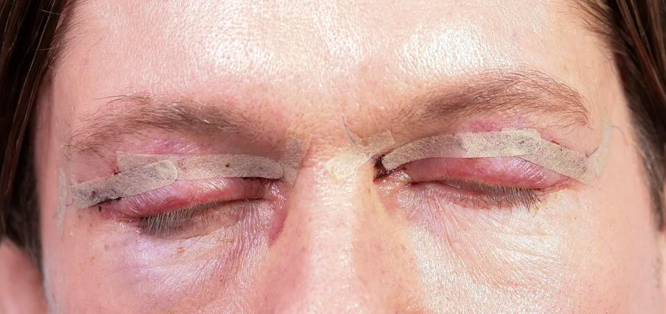 Plastic surgery Foto stock
