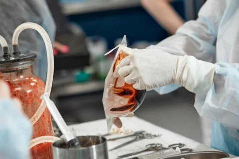 Plastic surgery to remove excess fat. Pumping fat into a jar during liposuction Stock Photos